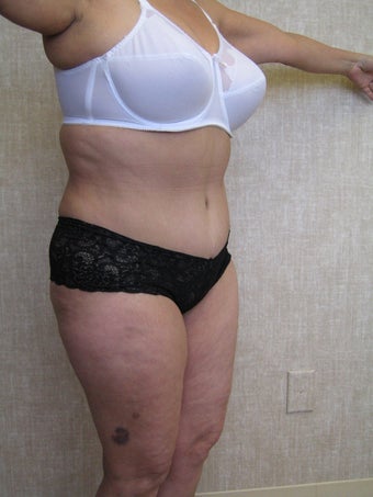 tummy tuck after 304679