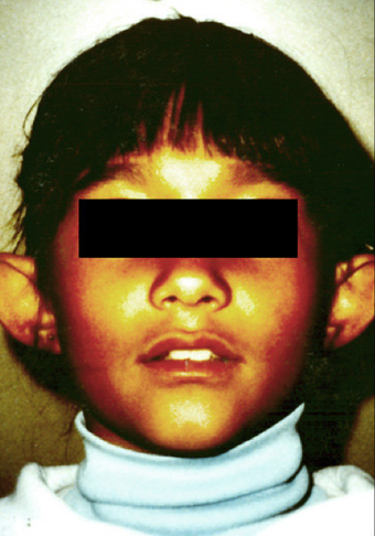 Otoplasty before 483144