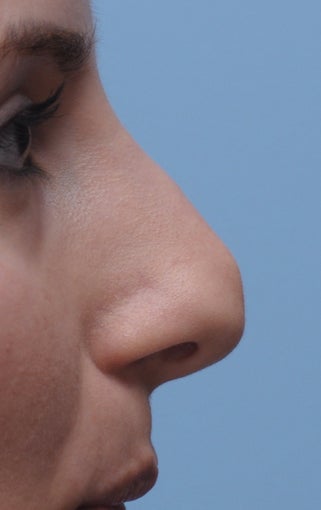 Rhinoplasty 361321