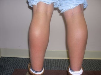 Calf Implants before 259000