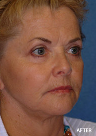 Facelift, Eyelid and Cheek Implant Surgery after 328079
