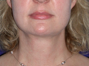 Necklift after 208455