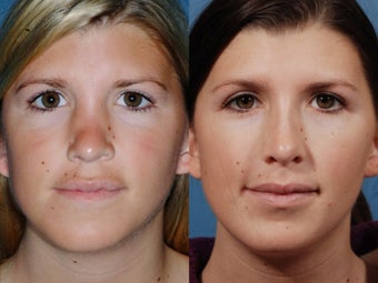 Revision rhinoplasty before 436945