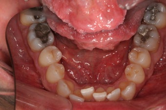 Invisalign 372721