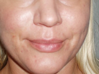 Lip Implants before 198656