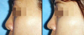 Rhinoplasty before 650754