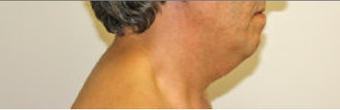 Chin Liposuction before 490761
