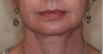 Ultherapy after 460347