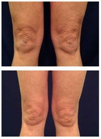 Laser Skin Tightening before 297816