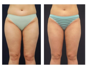 Liposuction before 392328