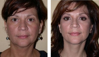 Necklift 359779