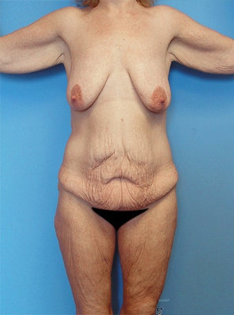 High-Definition™ Total Body Lift before 177430