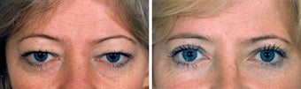 Blepharoplasty before 643234