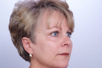 Endoscopic Brow Lift after 250451
