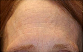 Fraxel - Photoaging before 652364
