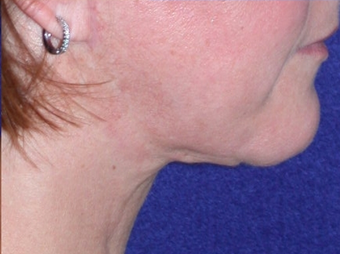 Necklift 208441