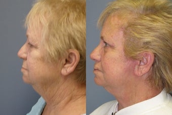 Lite Lift™, liposuction of the neck, brow lift, eyelid lift before 523711