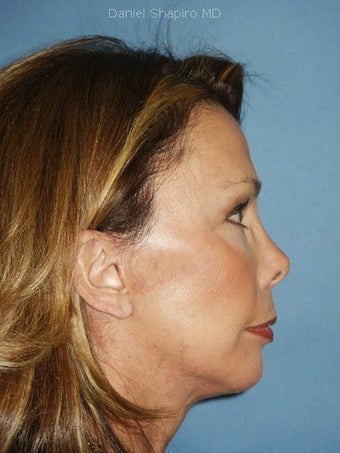 Chin augmentation with facial rejuvenation after 250151