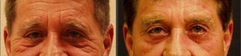 Brow Lift before 525339