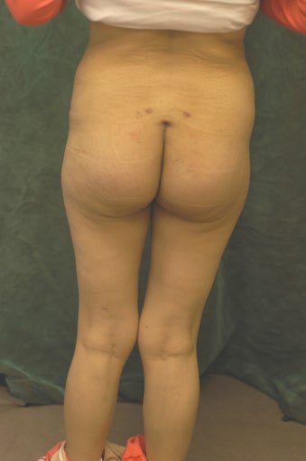 Women's Buttocks Augmentation 518115