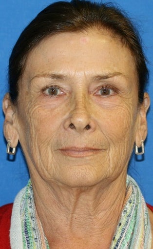 facelift before 264045