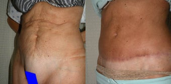 Tummy Tuck Revision after 400493