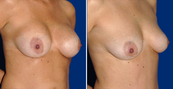 Breast Implant Removal after 495858