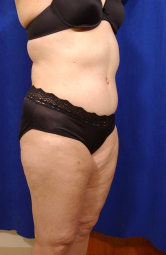 Abdominoplasty with liposculpture of abs, flanks, and waist after 82415