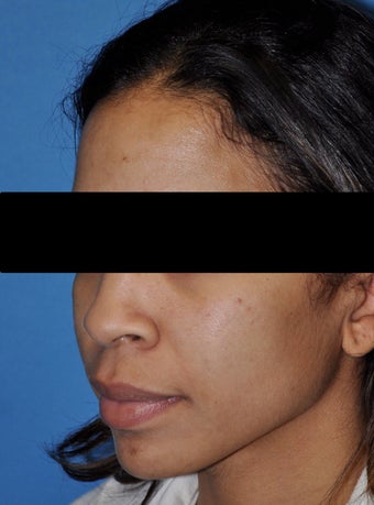 African American Rhinoplasty before 364919