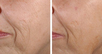 Fractional Skin Resurfacing Before and After Fractional Skin Resurfacing before 69341
