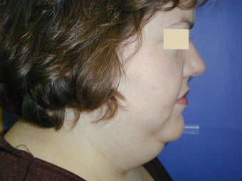 Neck Liposuction before 93325