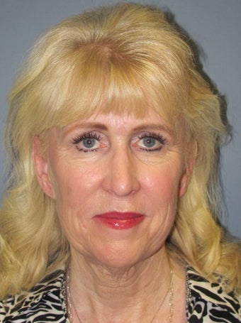 Neck Lift, Platysmaplasty before 634754