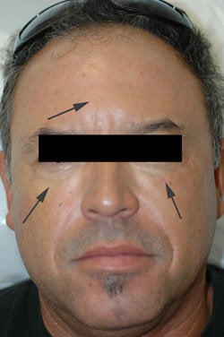 Restylane for dark circles under the eyes after 91059