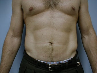 Male contouring liposuction after 590924