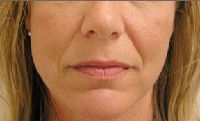 Juvederm before 314274