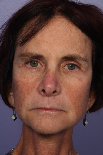 Neck lift after 306410