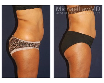 Lower Body Lift 500848