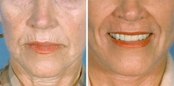 Chemical Peel before 652169