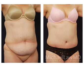 Abdominoplasty - Tummy Tuck after 396103