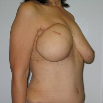 Nipple Reconstruction 523521