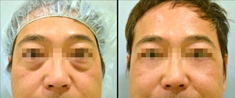 Lower Eyelid(Blepharoplasty) Surgery before 650682