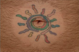 QSR Ruby Laser Tattoo Removal before 329675