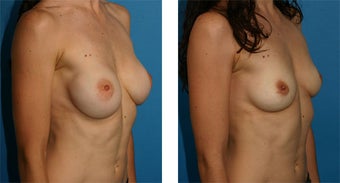Breast Implant Removal with Internal Lift 562127