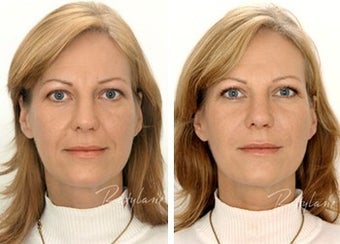 Before and after restylane full face before 6274