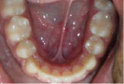 Braces and Extraction 349028