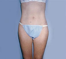 Smartlipo after 401656