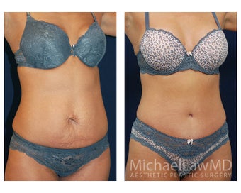 Abdominoplasty - Tummy Tuck after 396068