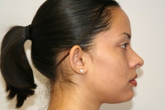 Otoplasty 320201
