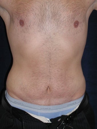 Male Tummy Tuck, Flank Liposuction, Male Breast Reduction after 578191