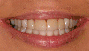 Whitening before 385392